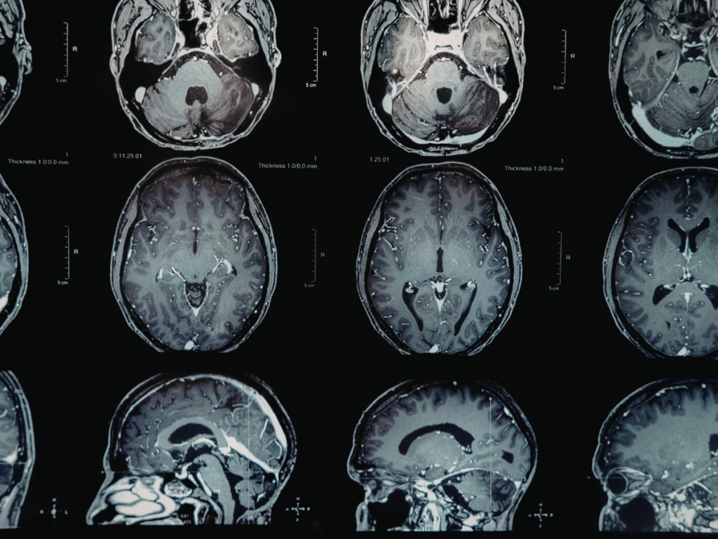 Researchers Map the ‘Neural Fingerprint’ Shared by All Major Psychedelics